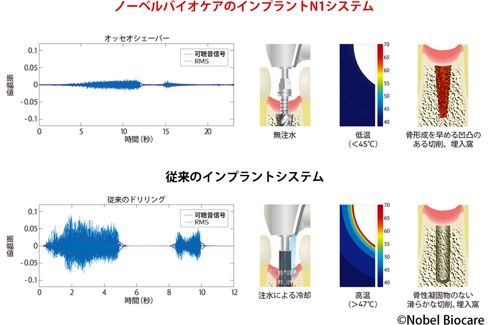 生体に優しいドリルでインプラント体と顎骨の結合を促進